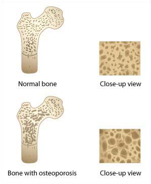 osteoporosis pilates